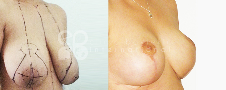 lfbreast-ba3